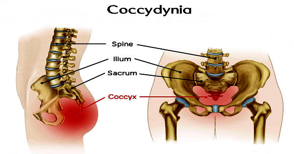NSAIDs (non-steroidal anti-inflammatory drugs) for Tailbone Pain, Coccyx  Pain, Coccydynia