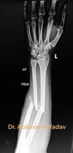 Both bone forearm fracture