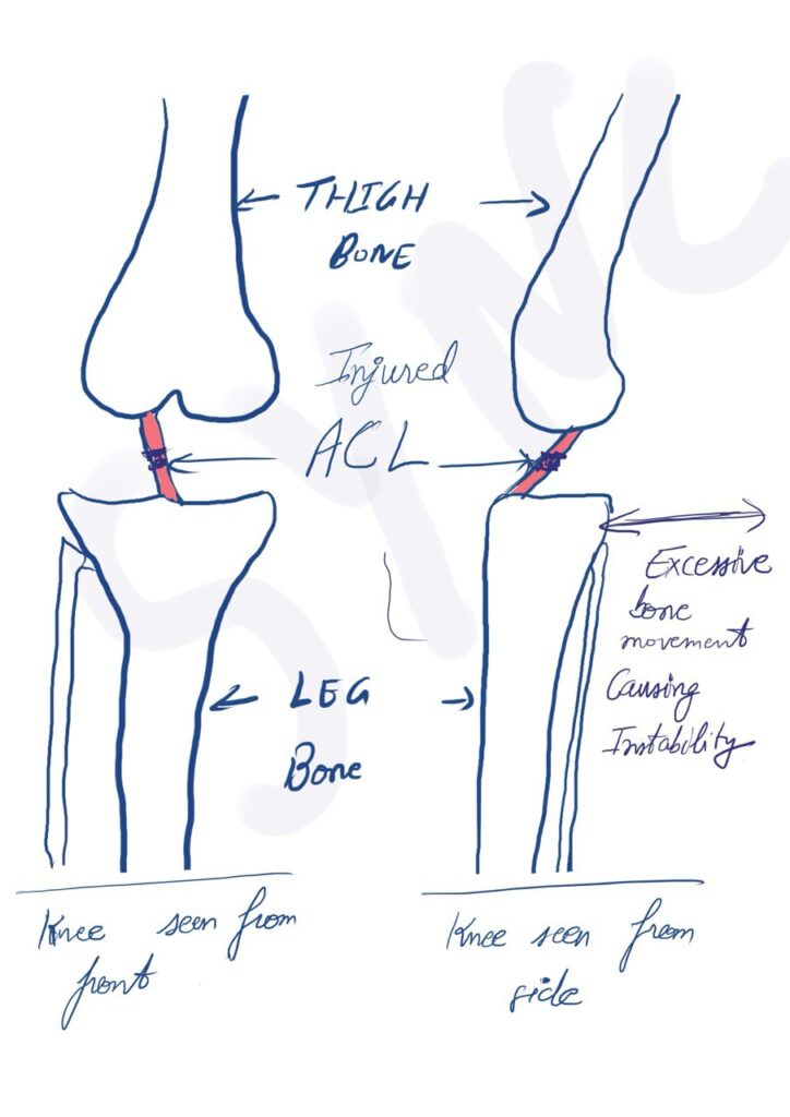 Injury Anterior Cruciate Ligament (ACL)